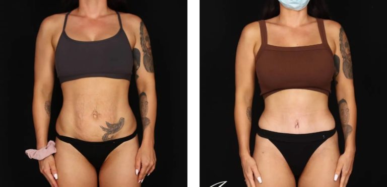 Circumferential Abdominoplasty, before and after 1, Dr Anh Perth