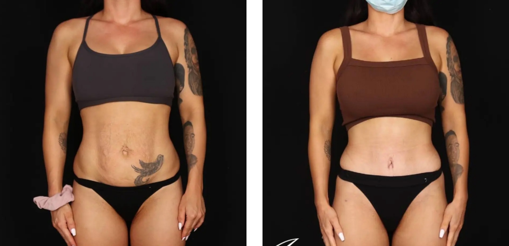 Circumferential Abdominoplasty, before and after 1, Dr Anh Perth