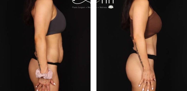Circumferential Abdominoplasty, before and after 2, Dr Anh Perth