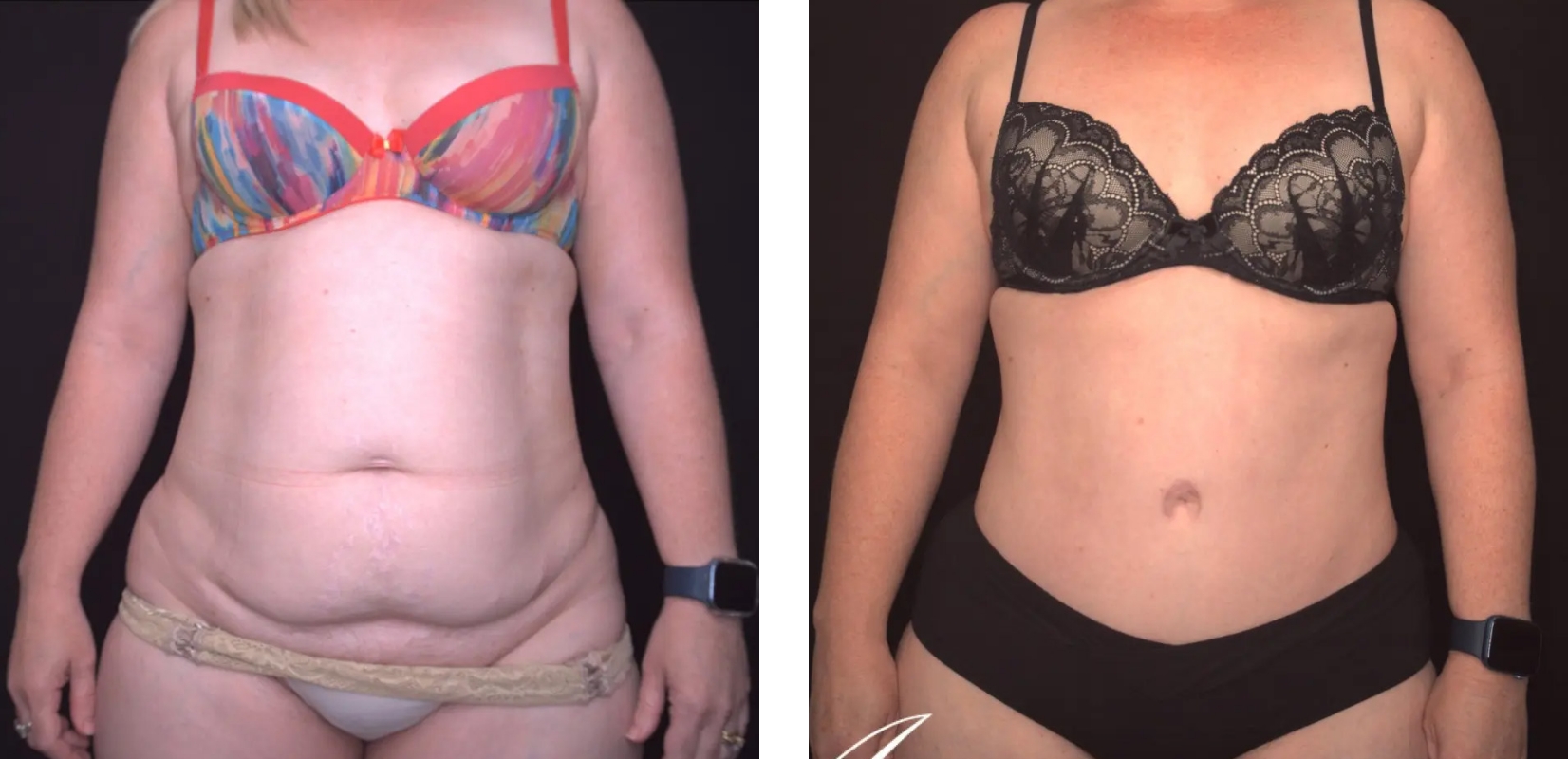Fleur De Lys Abdominoplasty, before and after 1, Dr Anh Perth