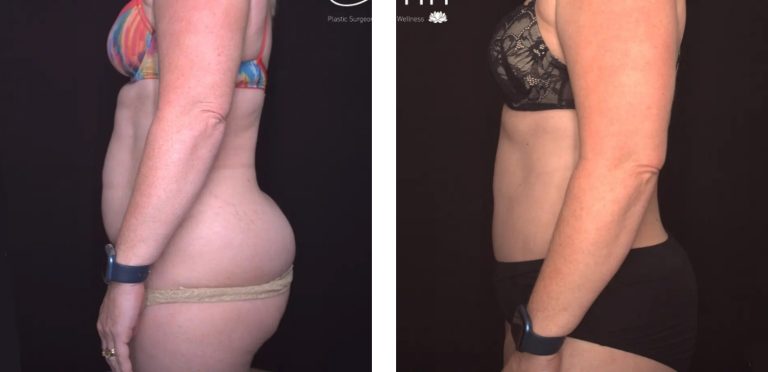 Fleur De Lys Abdominoplasty, before and after 2, Dr Anh Perth Plastic Surgeon