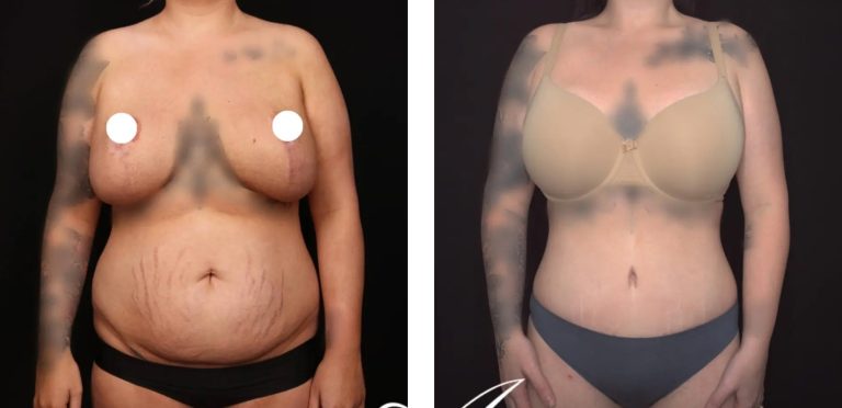 Mini abdominoplasty, before and after 1, Dr Anh Perth