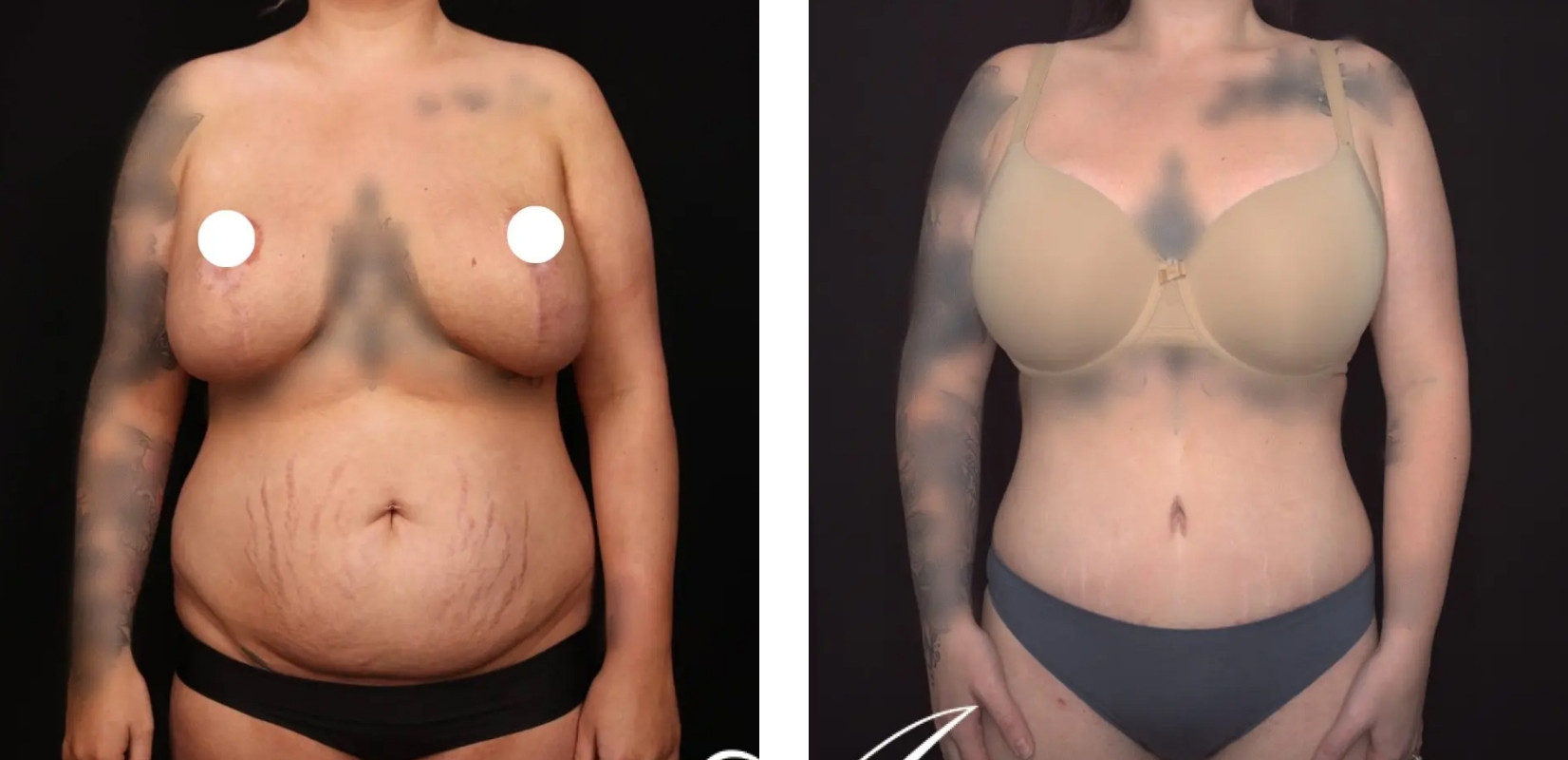 Mini abdominoplasty, before and after 1, Dr Anh Perth