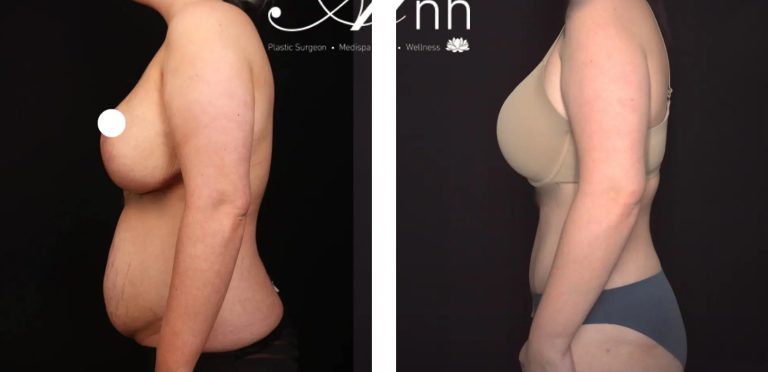 Mini-abdominoplasty before and after 2, Dr Anh Perth WA
