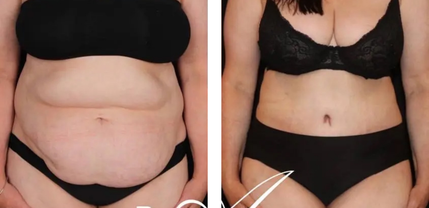 Abdominoplasty patient, before and after 5 1@2x, front view, Dr Anh Perth