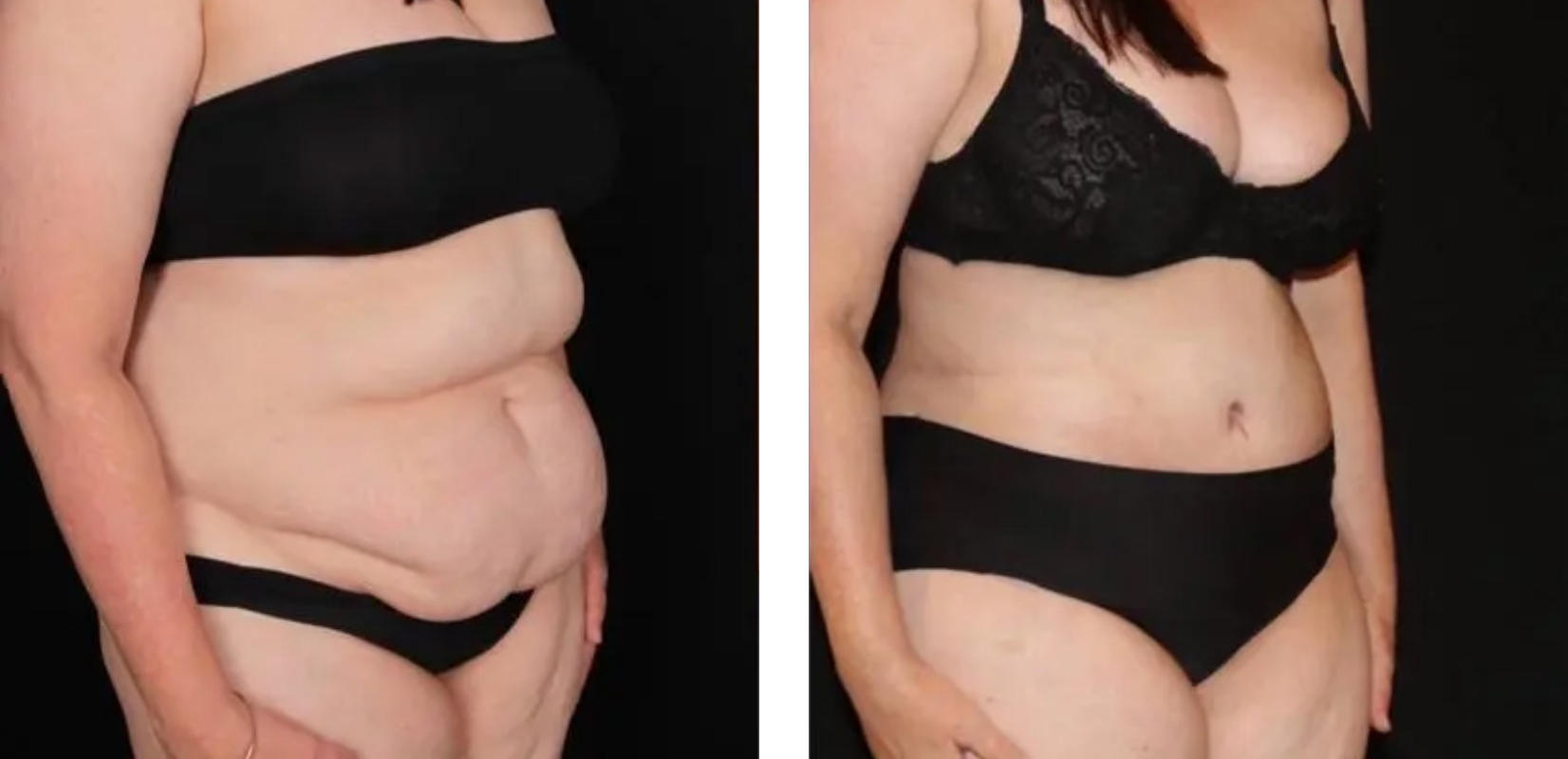 Abdominoplasty patient, before and after 5 2@2x, angle view, Dr Anh Perth