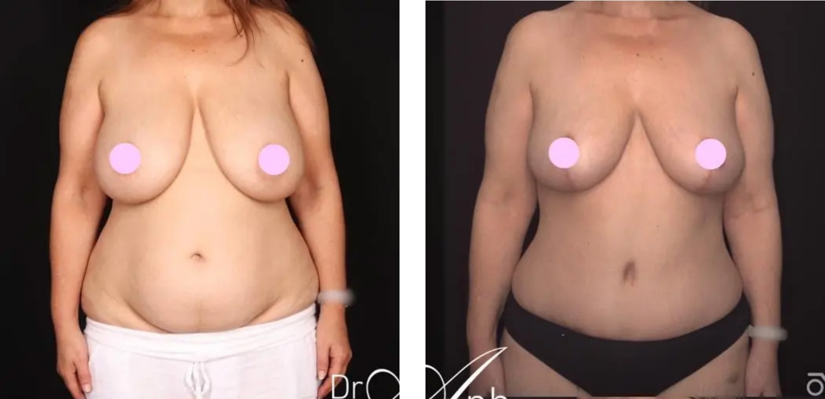 Abdominoplasty, before and after 6 1@2x, front view, Dr Anh Nguyen Plastic Surgery Perth