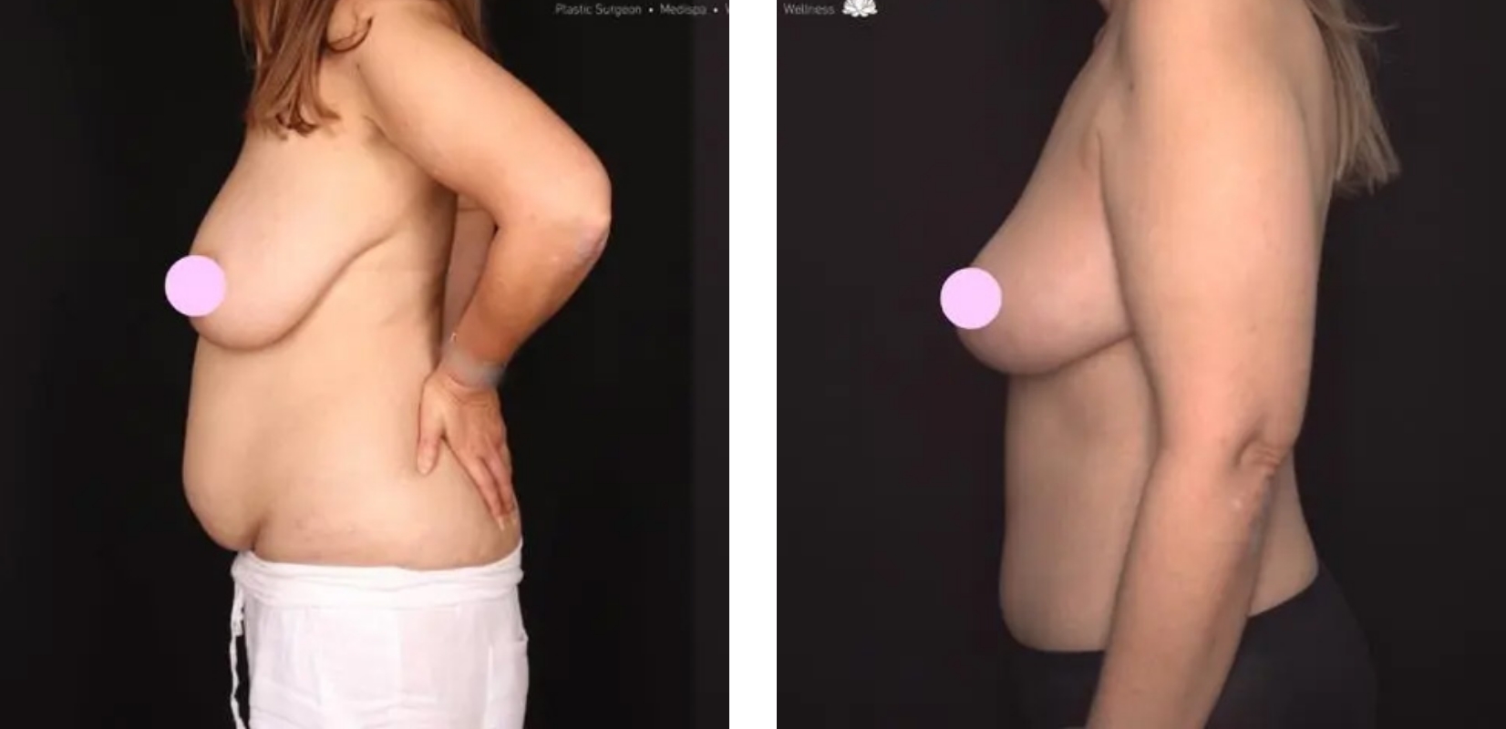 Abdominoplasty, before and after 6 2@2x, side view, Dr Anh Nguyen Plastic Surgery Perth