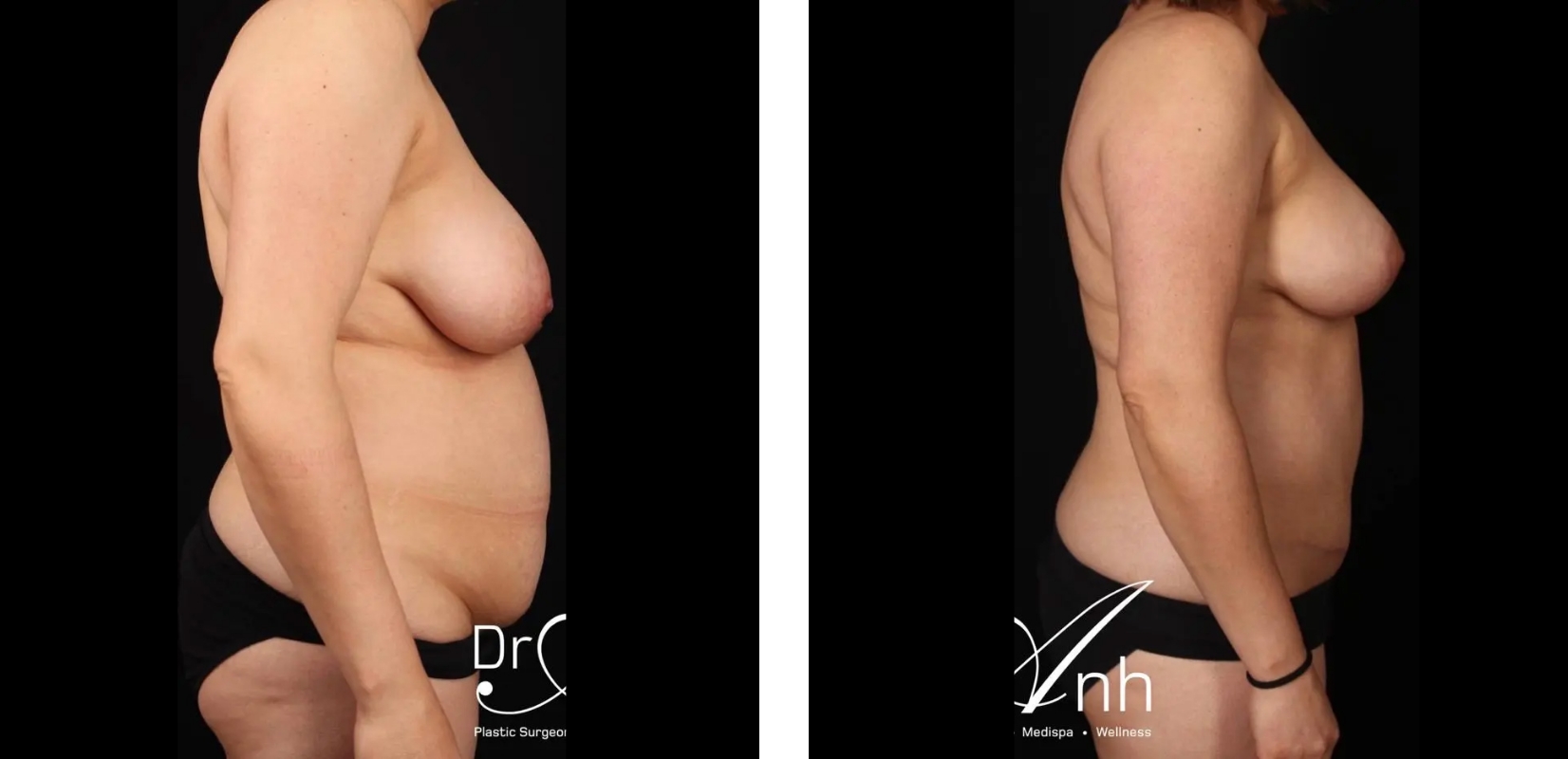 Abdominoplasty, before and after 7 1@2x, side view, Dr Anh Nguyen Plastic Surgery