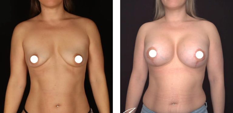 Breast augmentation and lift, before and after 10 1@2x, front view, Dr Anh Perth