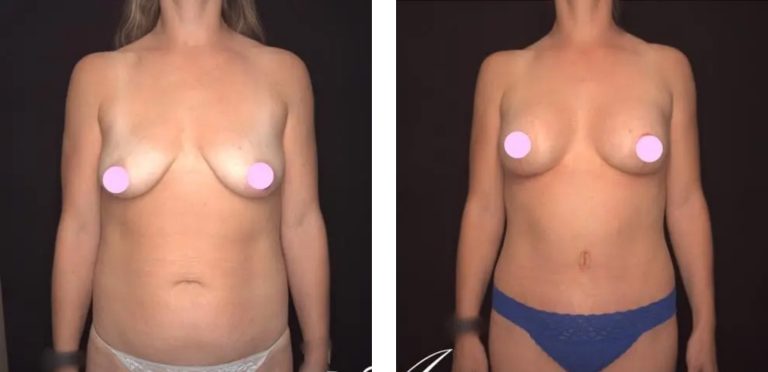 Combined surgery - Breast Lift-Mastopexy and Augmentation, Abdominoplasty Patient 1 1@2x, Dr Anh