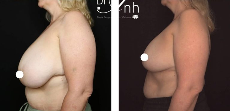 Breast reduction surgery before and after 8 2@2x, side view, Dr Anh Perth