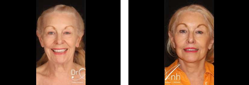 Older female facelift patient 4 1@2x, before and after the surgery, angle view, Dr Anh Perth