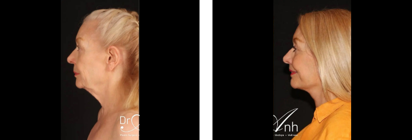 Older female facelift patient 4 2@2x, before and after the surgery, side view, Dr Anh Perth