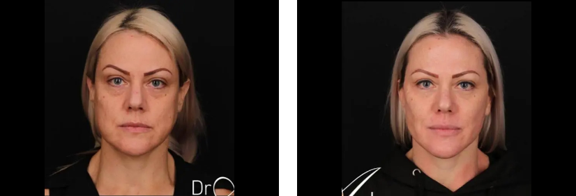 Facelift before and after 5 1@2x, Perth Plastic Surgeon Dr Anh