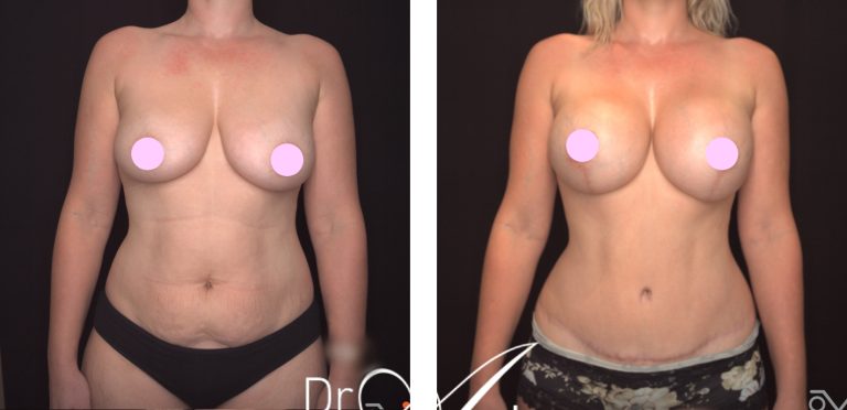 Abdominoplasty and breast augmentation with implants (post pregnancy body contouring), before and after 11, front view, Dr Anh Perth