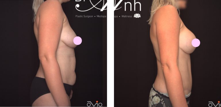 Breast augmentation and abdominoplasty (tummy tuck), before and after 11, side view, Dr Anh Nguyen Perth