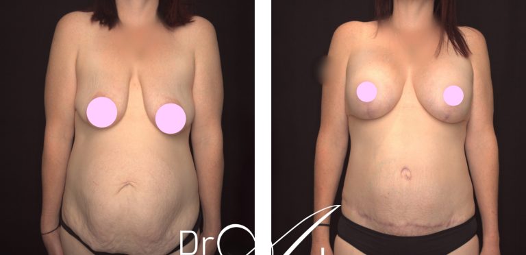 Abdominoplasty and breast reshaping surgery, before and after 12, front view, Perth Female Plastic Surgeon Dr Anh