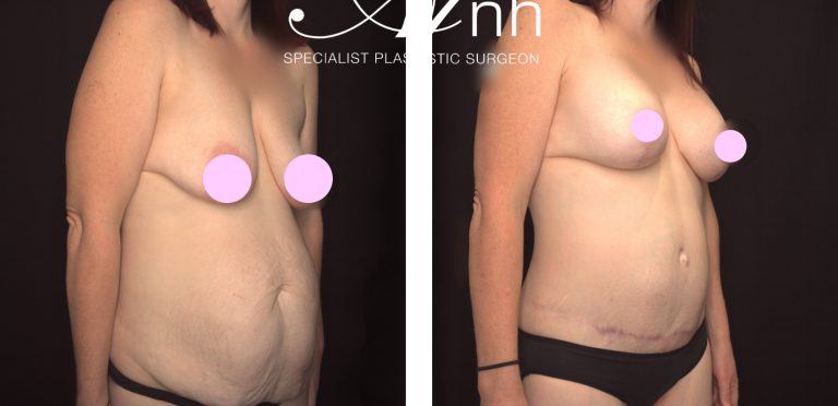Abdominoplasty body contouring surgery and breast lift, before and after 12, angle view, Dr Anh Perth
