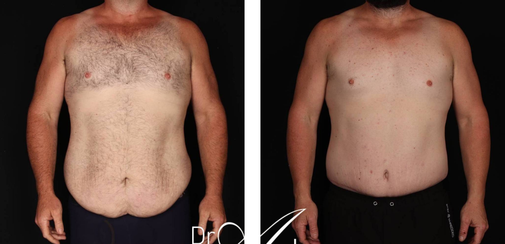 Male Abdominoplasty before and after 16 @2x, front view, Dr Anh Perth
