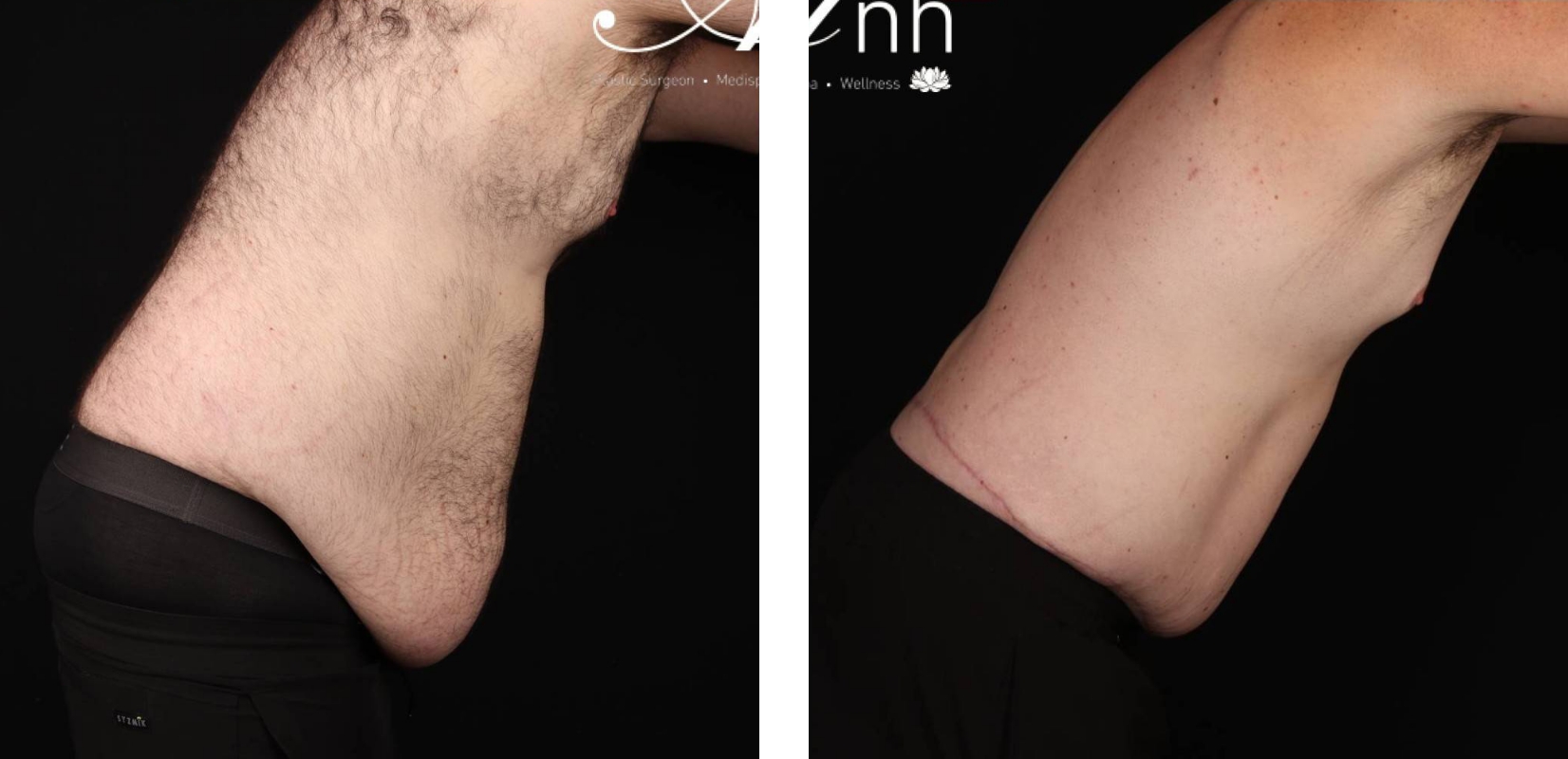 Male Abdominoplasty before and after 16 @2x, side view, Dr Anh Perth