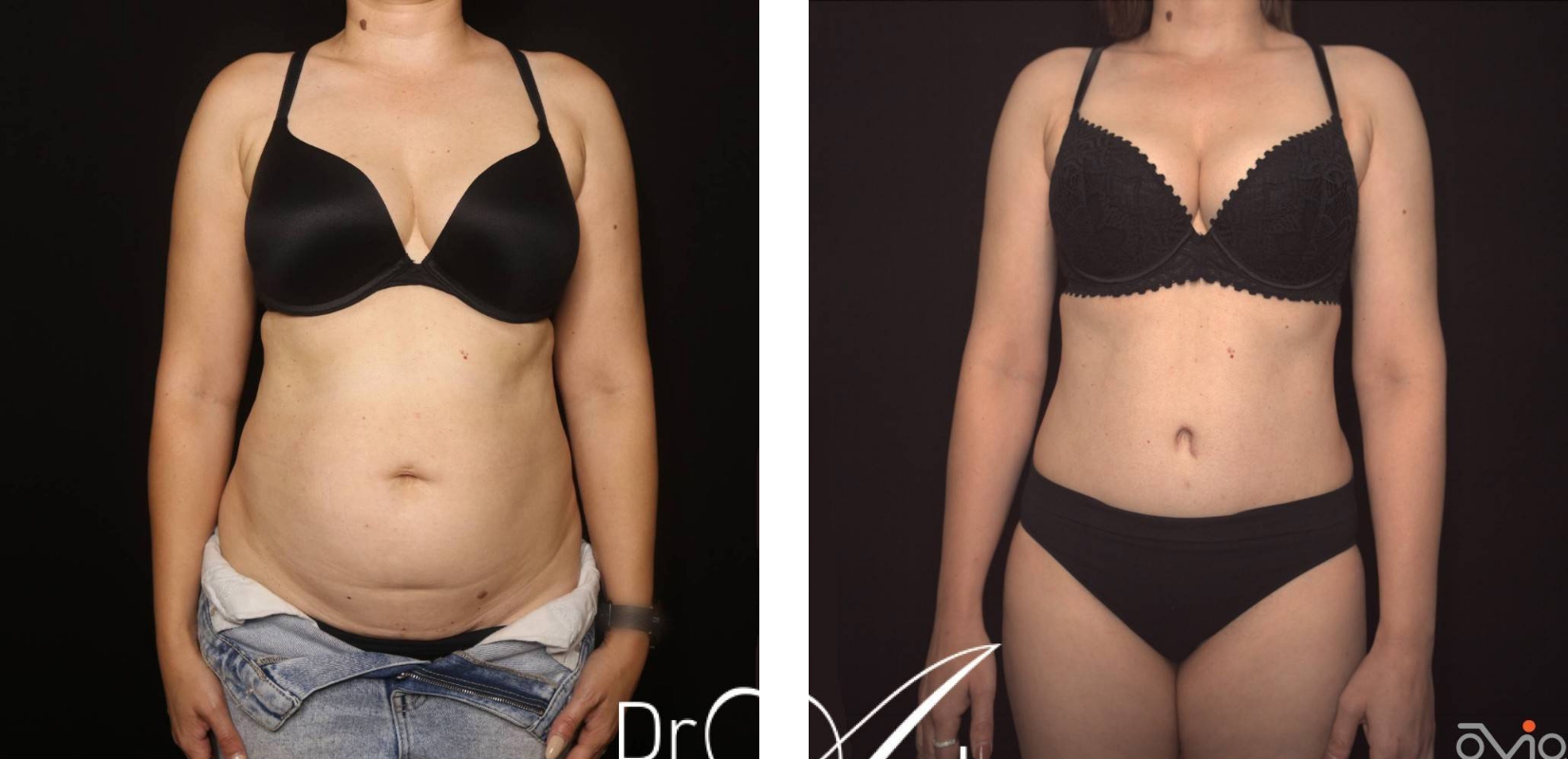Dr Anh Perth, Abdominoplasty before and after 17 @2x, front view, body contouring surgery
