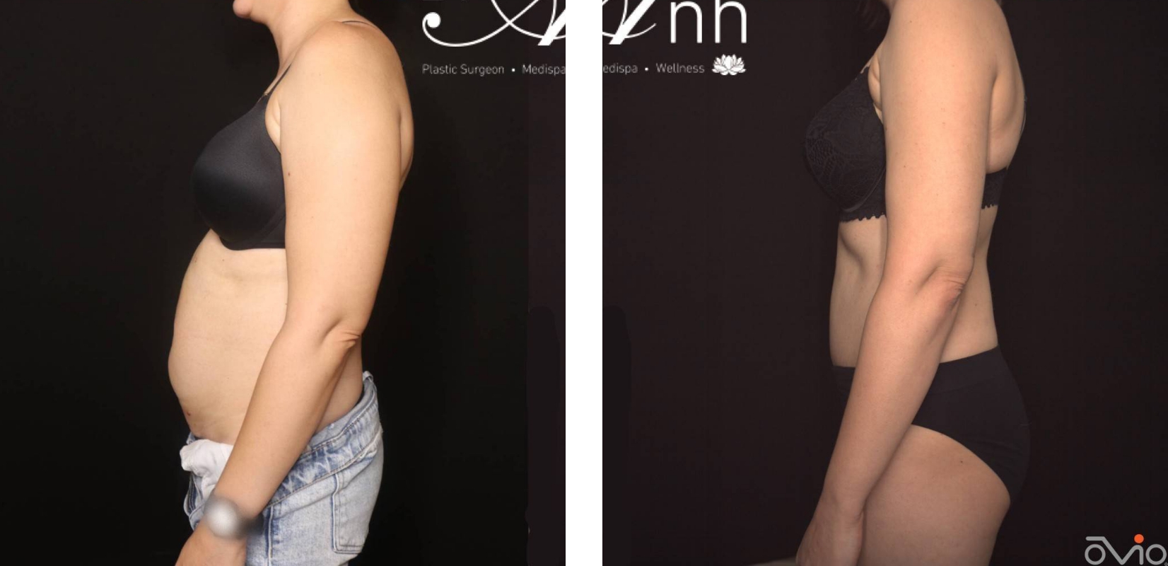 Dr Anh Perth, Abdominoplasty before and after 17 @2x, side view