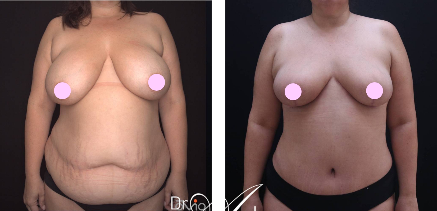 Abdominoplasty before and after 18 @2x, front view, Dr Anh Perth