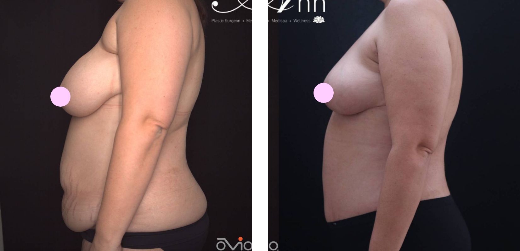 Abdominoplasty before and after 18 @2x, left side view, Dr Anh Body Contouring Plastic Surgery Perth