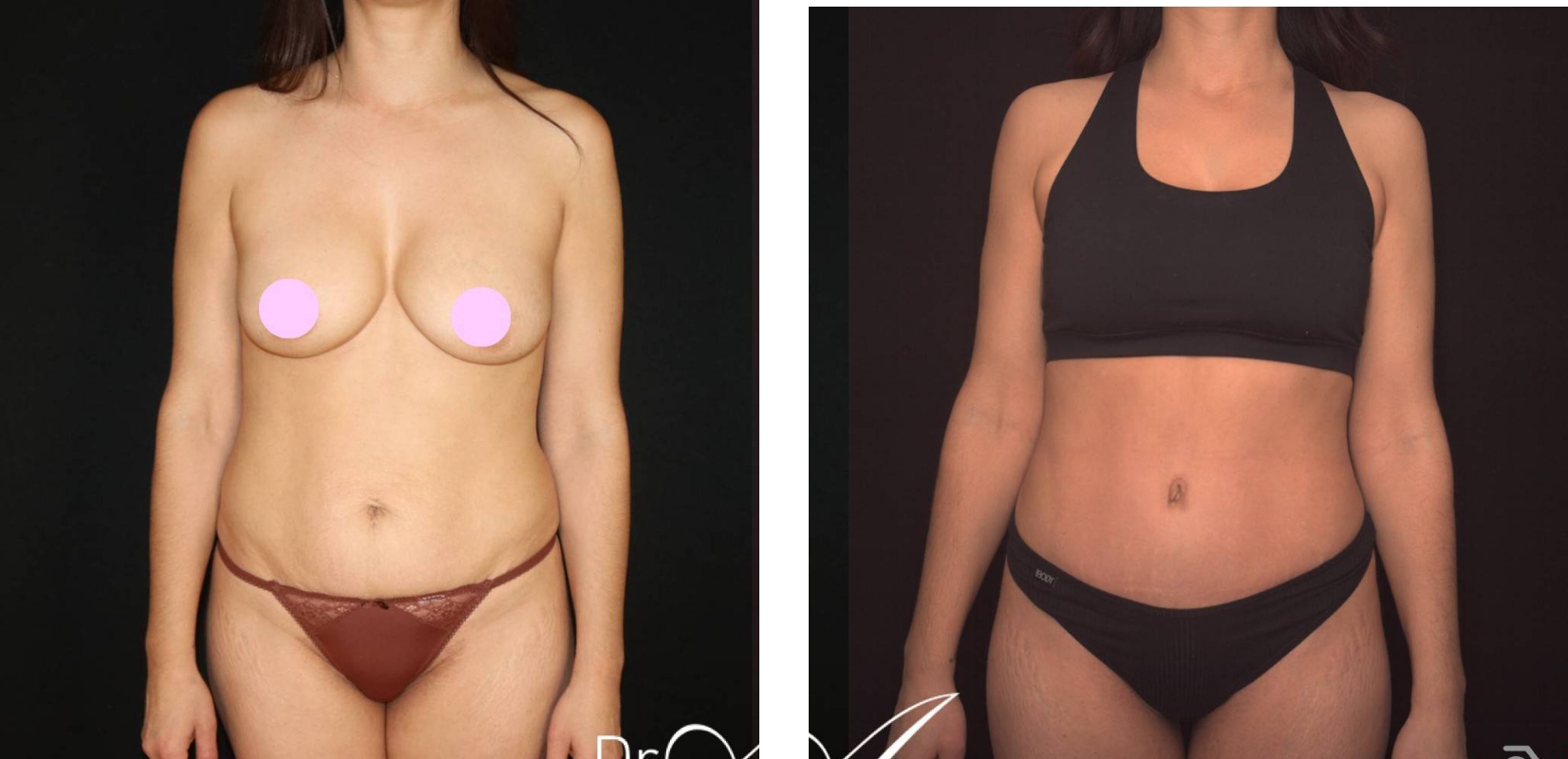 Abdominoplasty before and after 19 @2x, front view, Dr Anh Perth