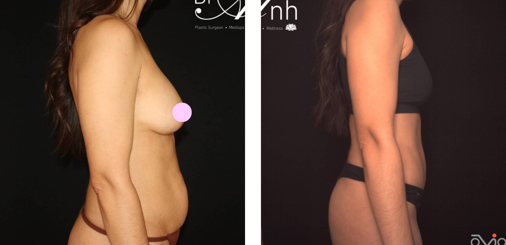 Abdominoplasty before and after 19 @2x, side view, Perth Plastic Surgeon Dr Anh