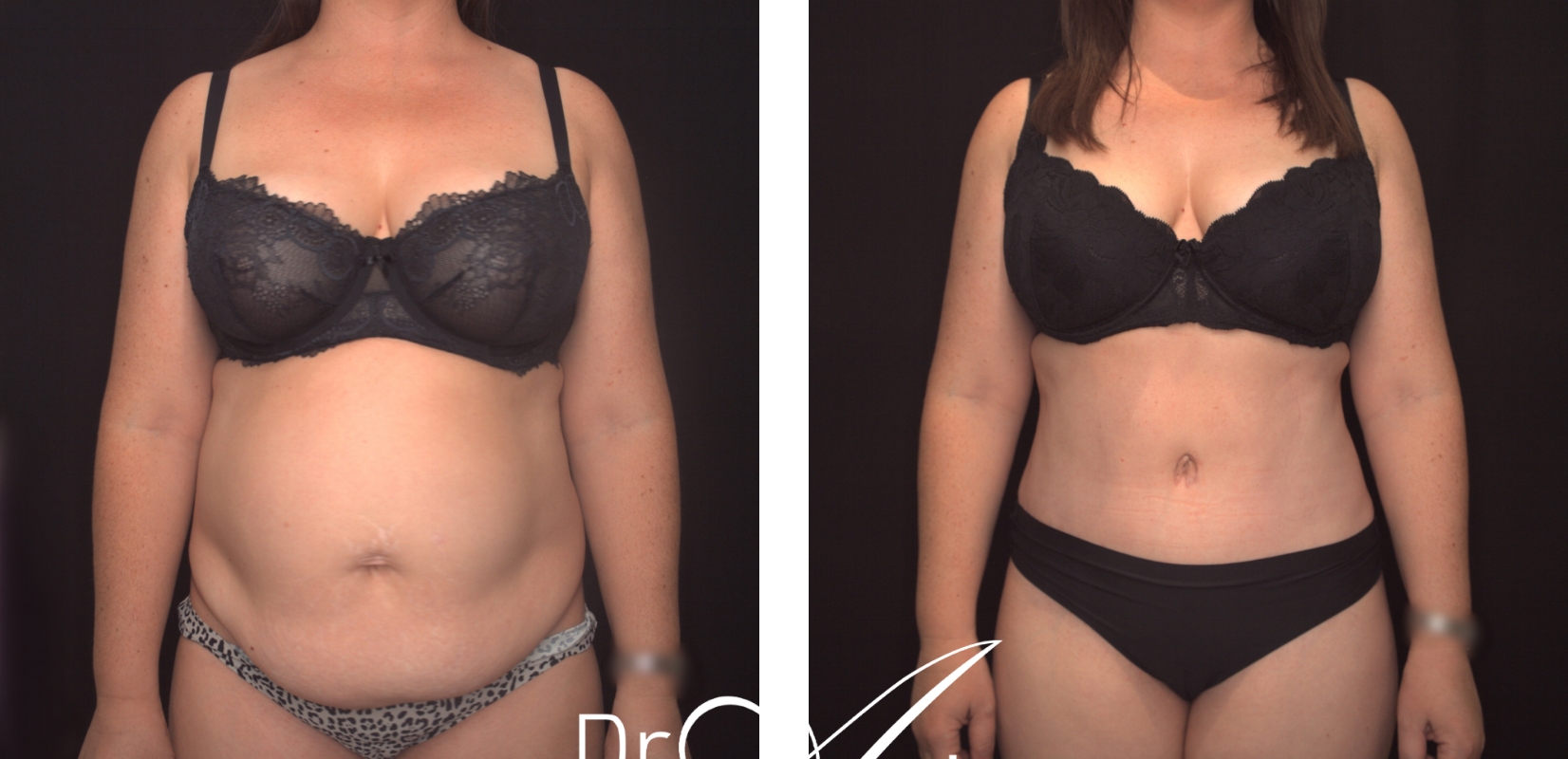 Abdominoplasty before and after 20 @2x, front view, Perth Female Plastic Surgeon Dr Anh