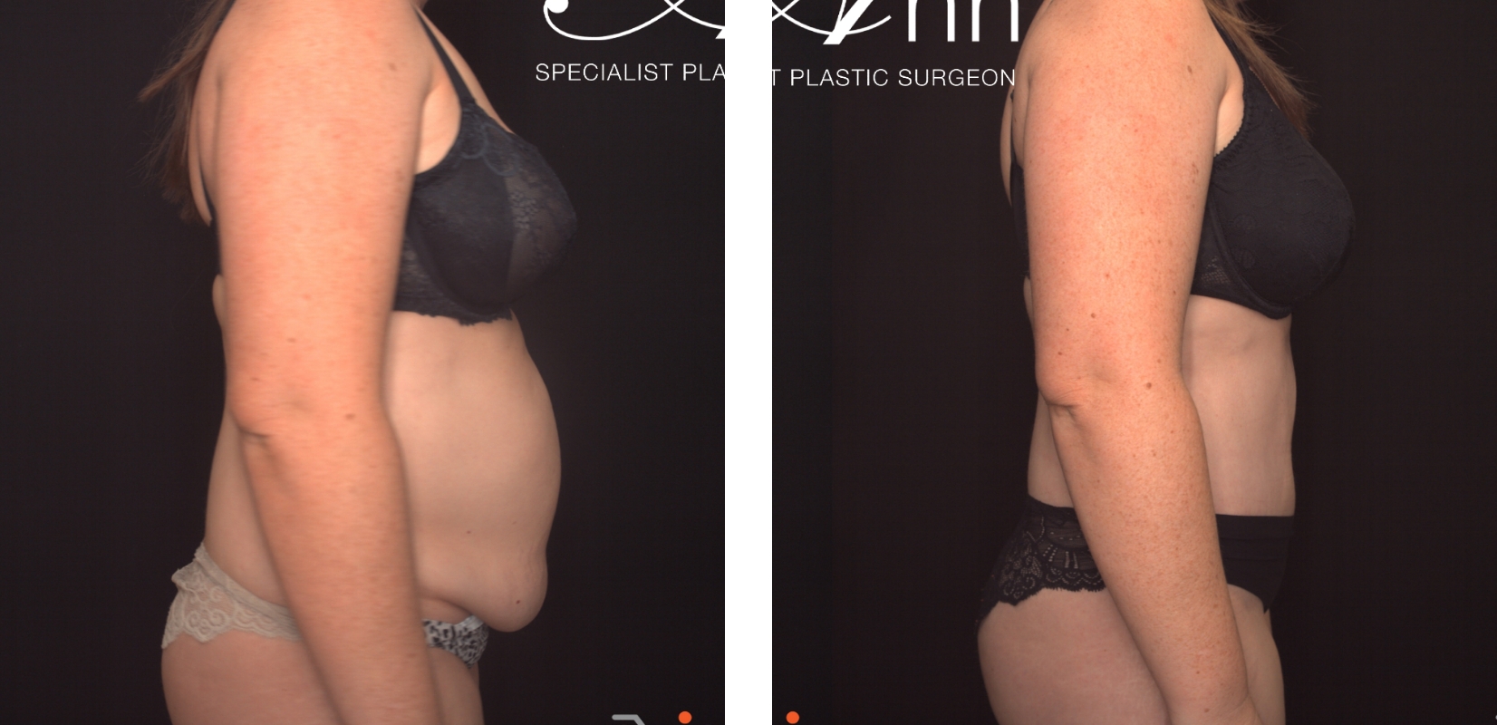 Dr Anh's patient before and after Abdominoplasty 20 @2x, right side view, Perth Female Plastic Surgeon
