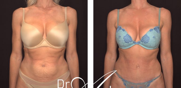 Dr Anh's patient before and after Abdominoplasty 21 @2x, front view, Perth Plastic Surgeon