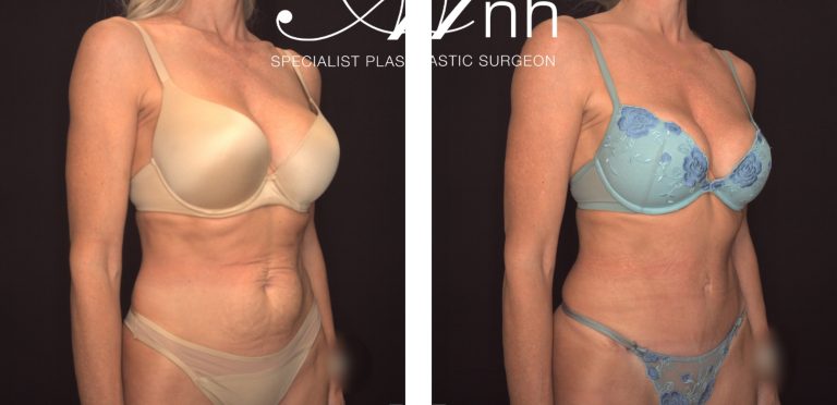 Dr Anh's patient before and after Abdominoplasty 21 @2x, angle view, Perth Female Plastic Surgeon