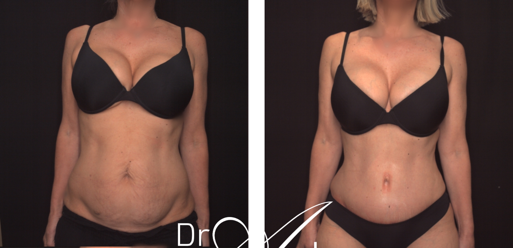 Abdominoplasty (body contouring surgery), before and after 22 @2x, front view, Dr Anh Perth