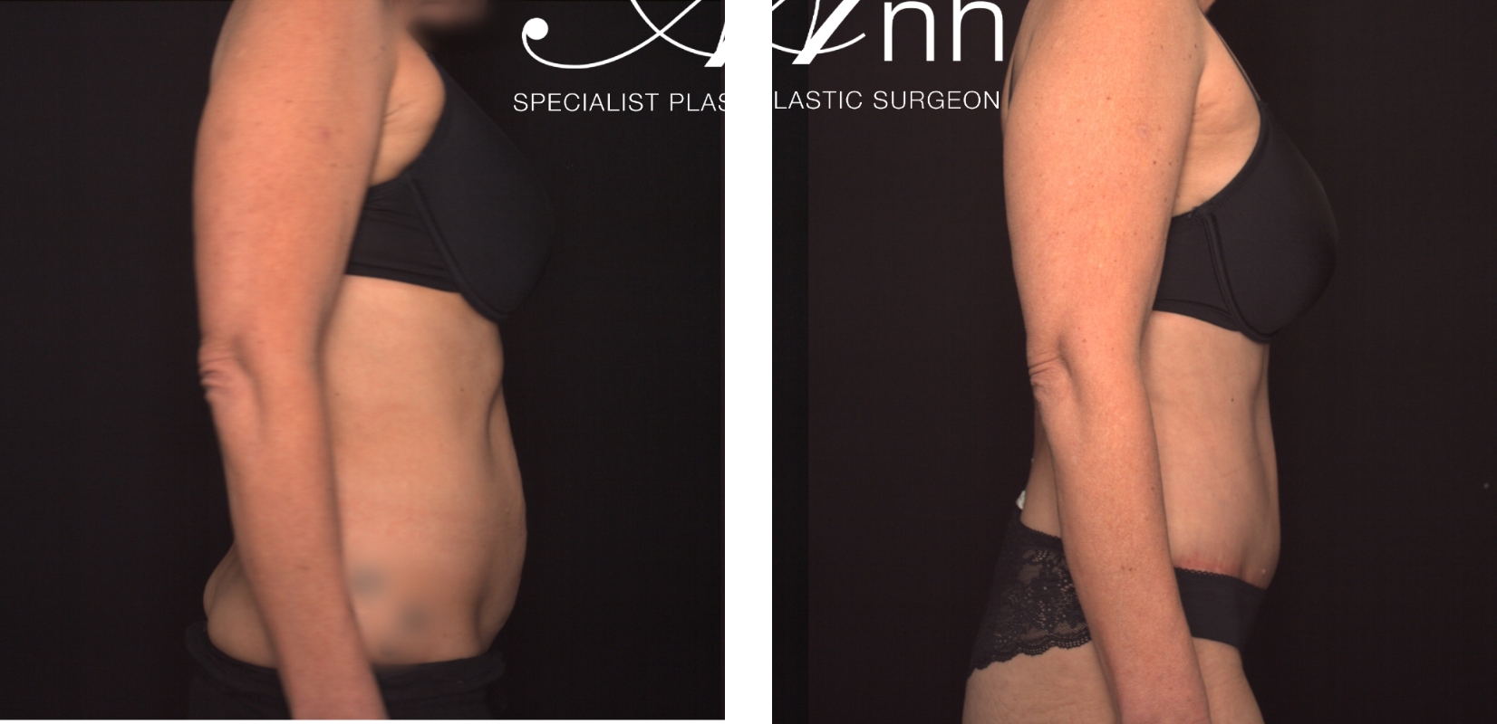 Abdominoplasty body contouring, before and after 22 @2x, side view, Dr Anh