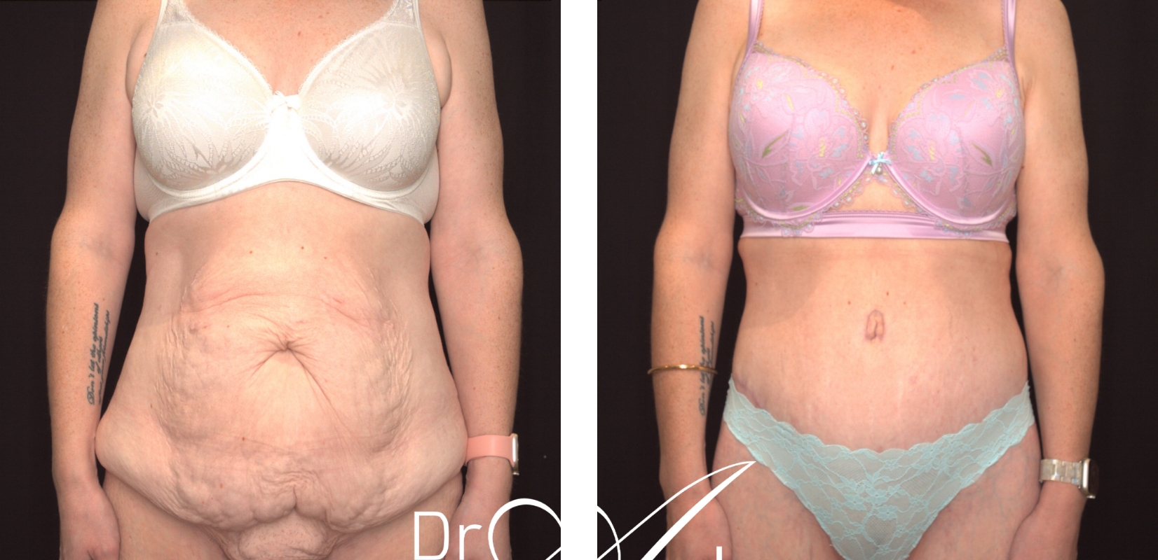 Dr Anh's abdominoplasty patient before and after surgery 23 @2x, front view, surgery results