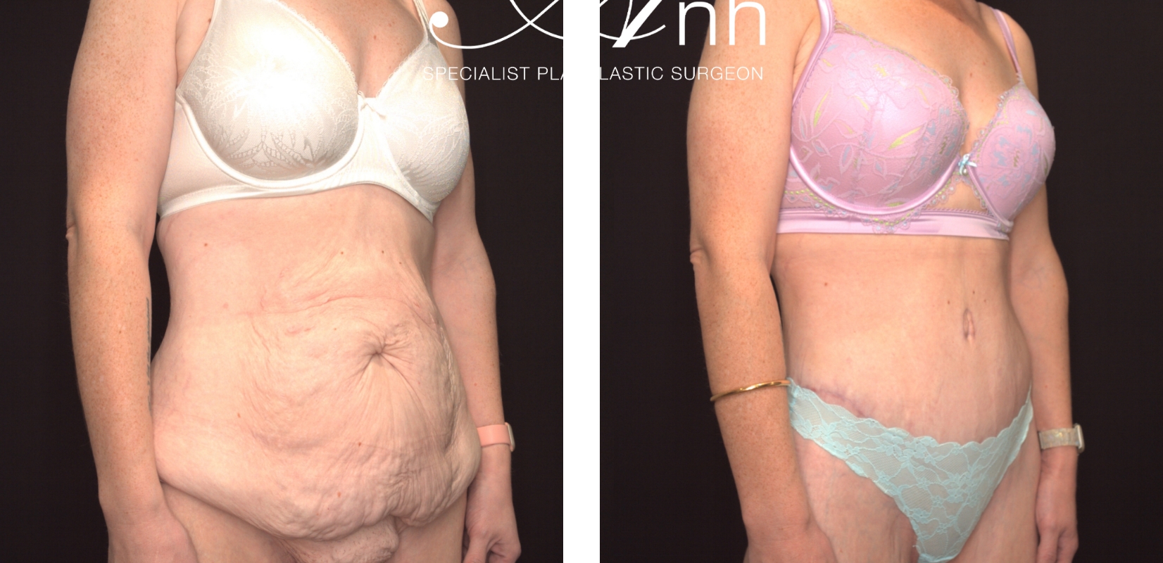 Abdominoplasty surgery before and after 23 @2x, angle view, Dr Anh Perth
