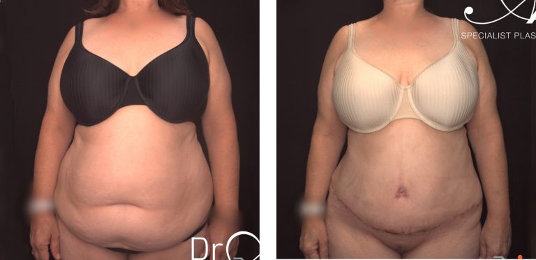 Abdominoplasty surgery before and after 24 @2x, Dr Anh Nguyen Perth