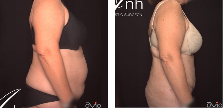 Abdominoplasty before and after 24 @2x, side view, Dr Anh Perth