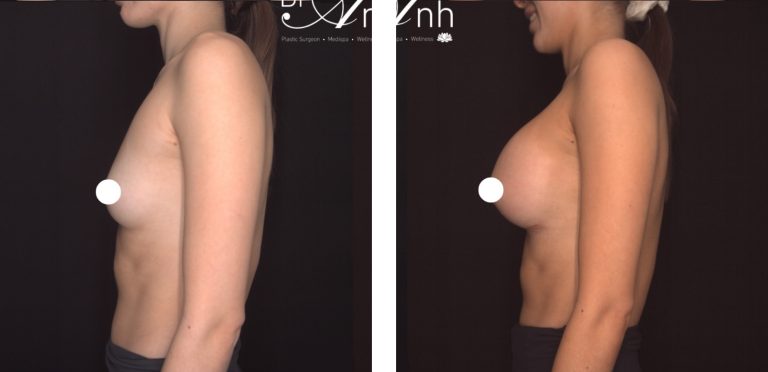 Breast augmentation with implants, before and after 13, left side view, Dr Nguyen Perth