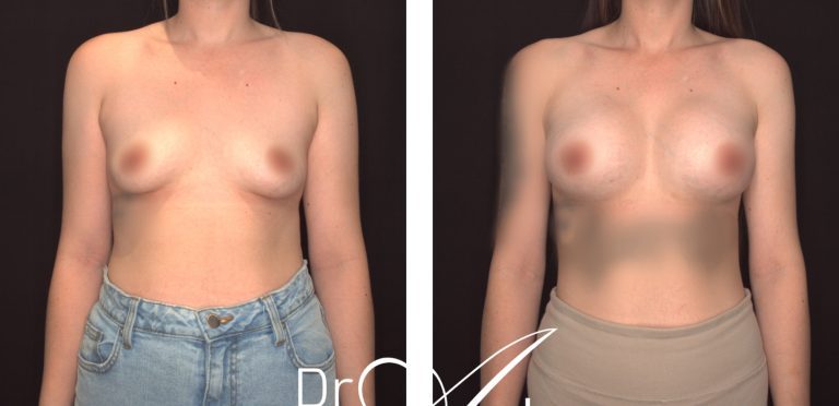 Breast implants surgery before and after 14, front view, Dr Anh Perth