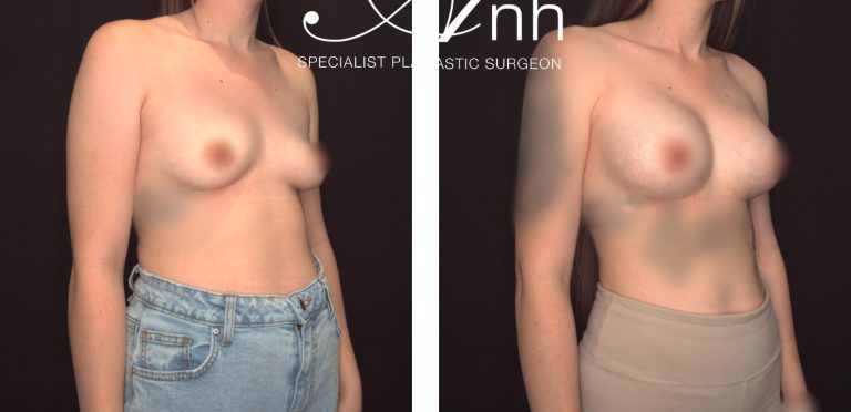 Breast implant surgery, before and after 14, angle view, Dr Anh Perth