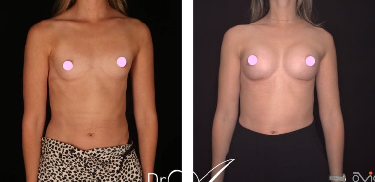 Breast augmentation (breast implants) before and after 15, front view, Dr Anh Nguyen Perth