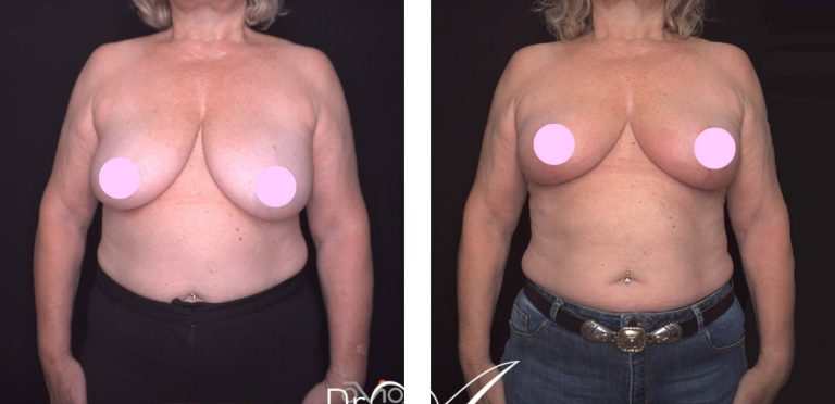 Breast uplift surgery, before and after 3, front view, Dr Anh Perth