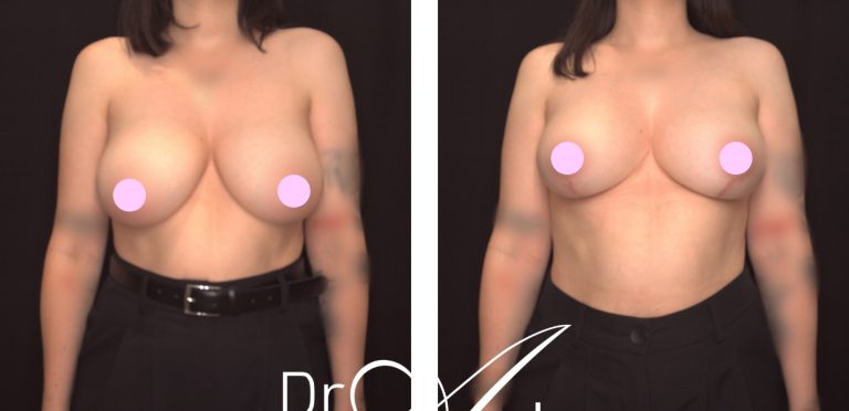 Breast reduction surgery (reduction mammoplasty), before and after 22 @2x, Dr Anh Perth