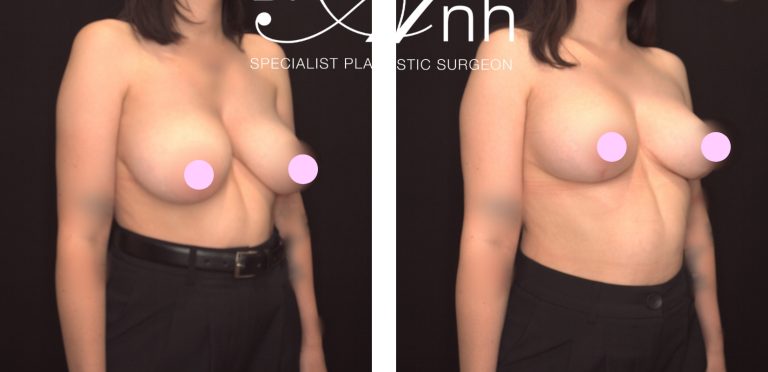 Breast reduction surgery before and after 22 @2x, angle view, Perth Female Plastic Surgeon Dr Anh