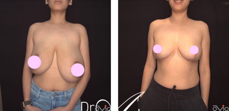 Breast reduction patient, before and after 23 @2x, front view