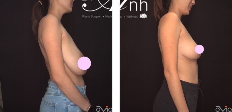 Breast reduction before and after 23 @2x, side view, Dr Anh Perth